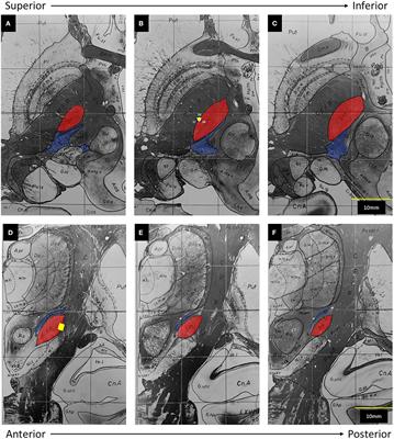 Commentary: Using Directional Deep Brain Stimulation to Co-activate the Subthalamic Nucleus and Zona Incerta for Overlapping Essential Tremor/Parkinson's Disease Symptoms